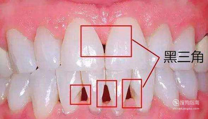 牙齿矫正黑三角是怎么造成的 产生黑三角怎么办