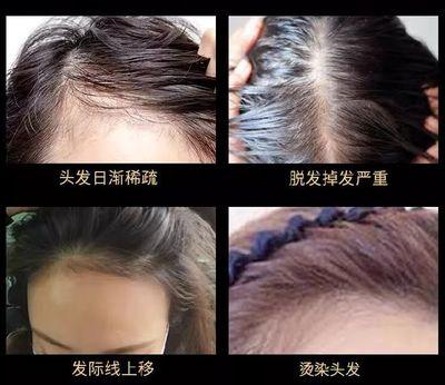 发际线上移就是脱发吗？