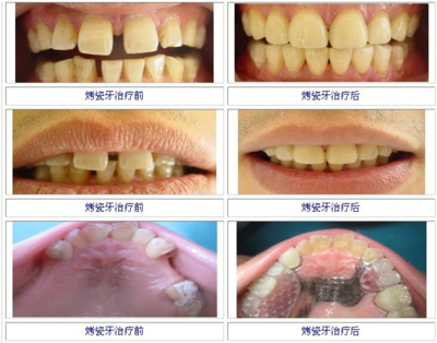 全口牙掉后该怎么办