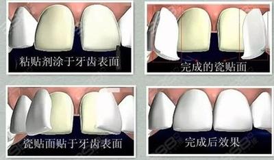 瓷贴面脱落该怎么办 瓷贴面脱落该怎么办
