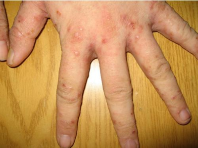 身上长了疥疮应该怎么办呢 用什么办法去除呢