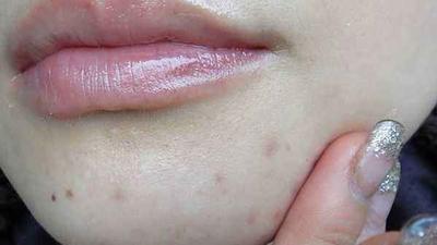 祛痘印最好的方法目前最有效的