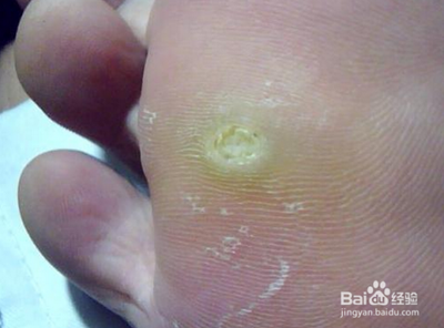 教大家如何无痛去除拓疣