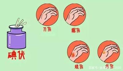 烧伤了可以用碘伏消毒吗 烧伤了怎么办最快最有效的方法