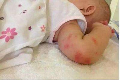 宝宝夏季如何驱蚊