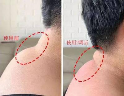 富贵包为什么越揉越大 富贵包一按就疼怎么办 富贵包为什么越揉越大 富贵包一按就疼怎么办
