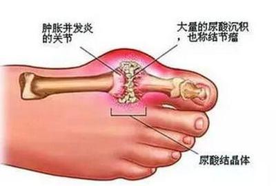 车前草有助于排结石吗 车前草对痛风起作用吗