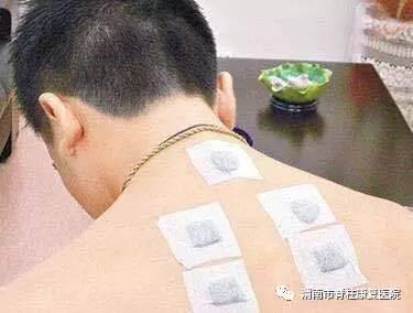 艾灸贴会上火吗 艾灸贴上火了怎么办