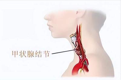 中医治疗肿瘤 中医治疗甲状腺结节效果好吗