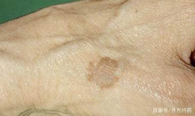 老年斑用什么药膏可以有效去除呢