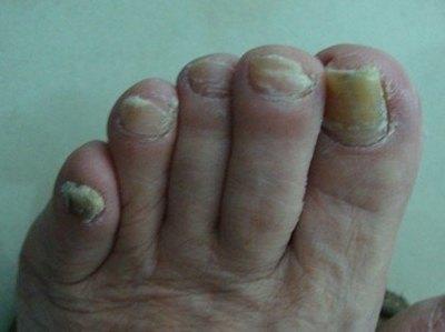 脚趾甲不好和肝脏有关系吗 灰指甲与肝有什么关系